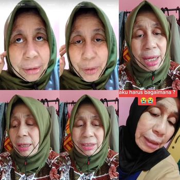 Viral! Wanita Bogor Idap Penyakit Langka, Usia Baru 28 Tahun Tapi Wajah Nenek-nenek