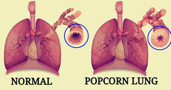Bukan Hanya 'Popcorn Lung', Vapers Juga Terancam Penyakit Paru Jenis ini
