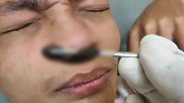 Cuci Muka di Sawah, Hidung Pria di Bogor Dimasuki Lintah